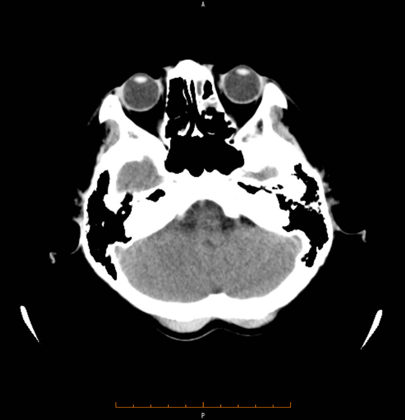 頭部CT写真